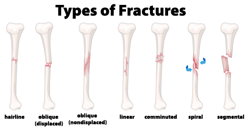 Types of Fractures 