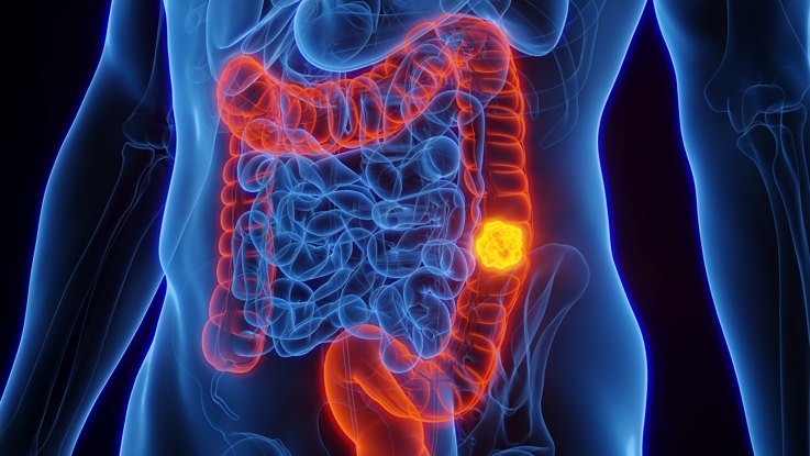Colon Health: What You Need to Know