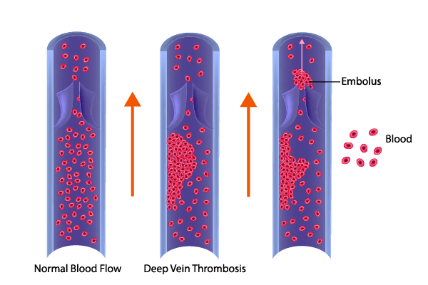 diagram of veins with and without DVT