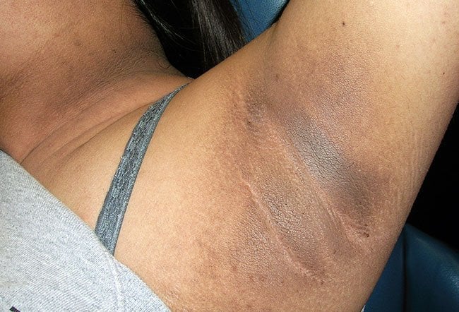 acanthosis-nigricans