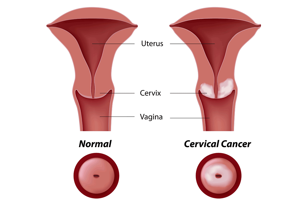 healthy cervix verus cervix with cancer