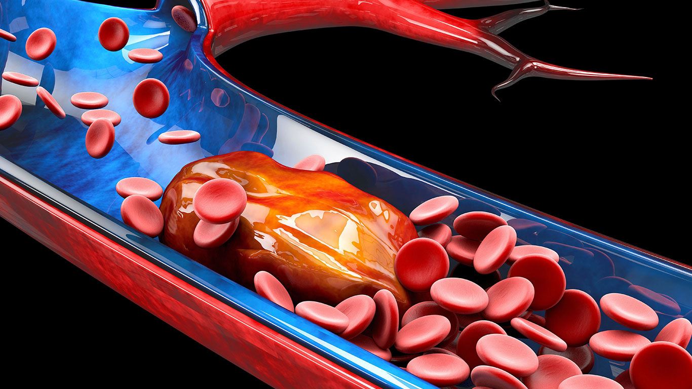 Tips for DVT Prevention Lompoc Valley Medical Center