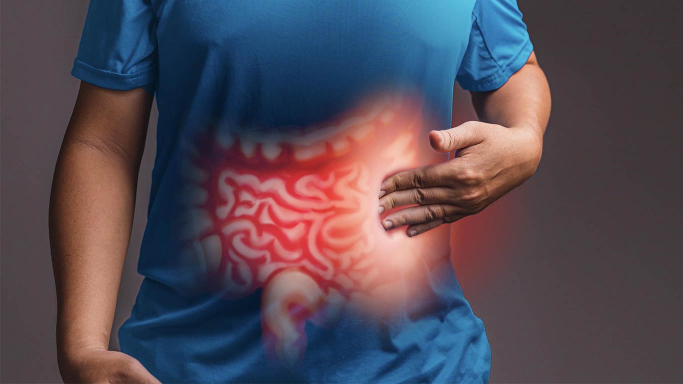 IBD illustration