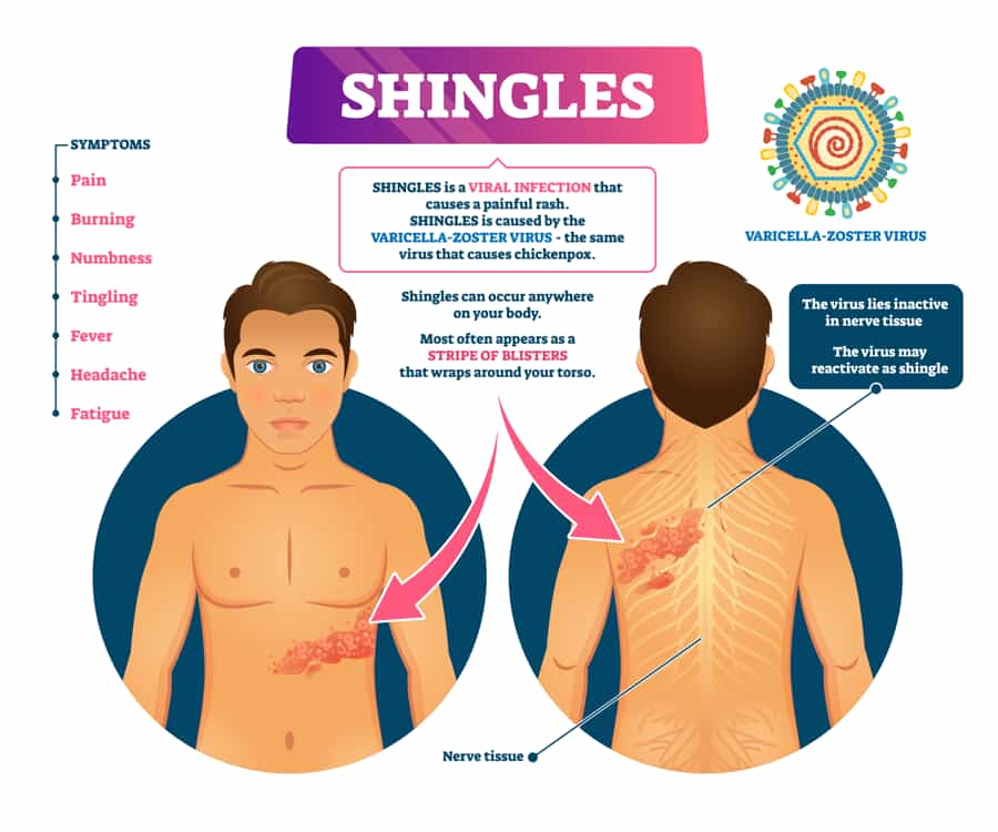 Shingles