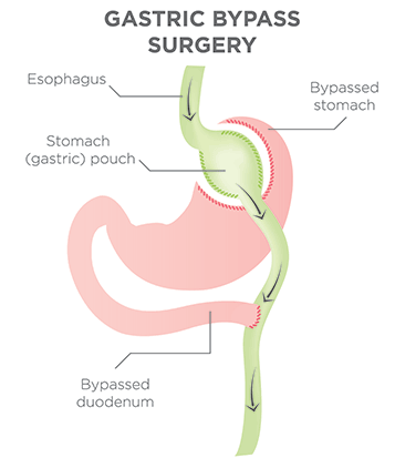 gastric bypass diagram 