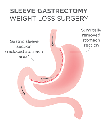 Types of Gastrectomy